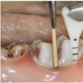 The Benefits of Air Abrasion for Cavity Treatment